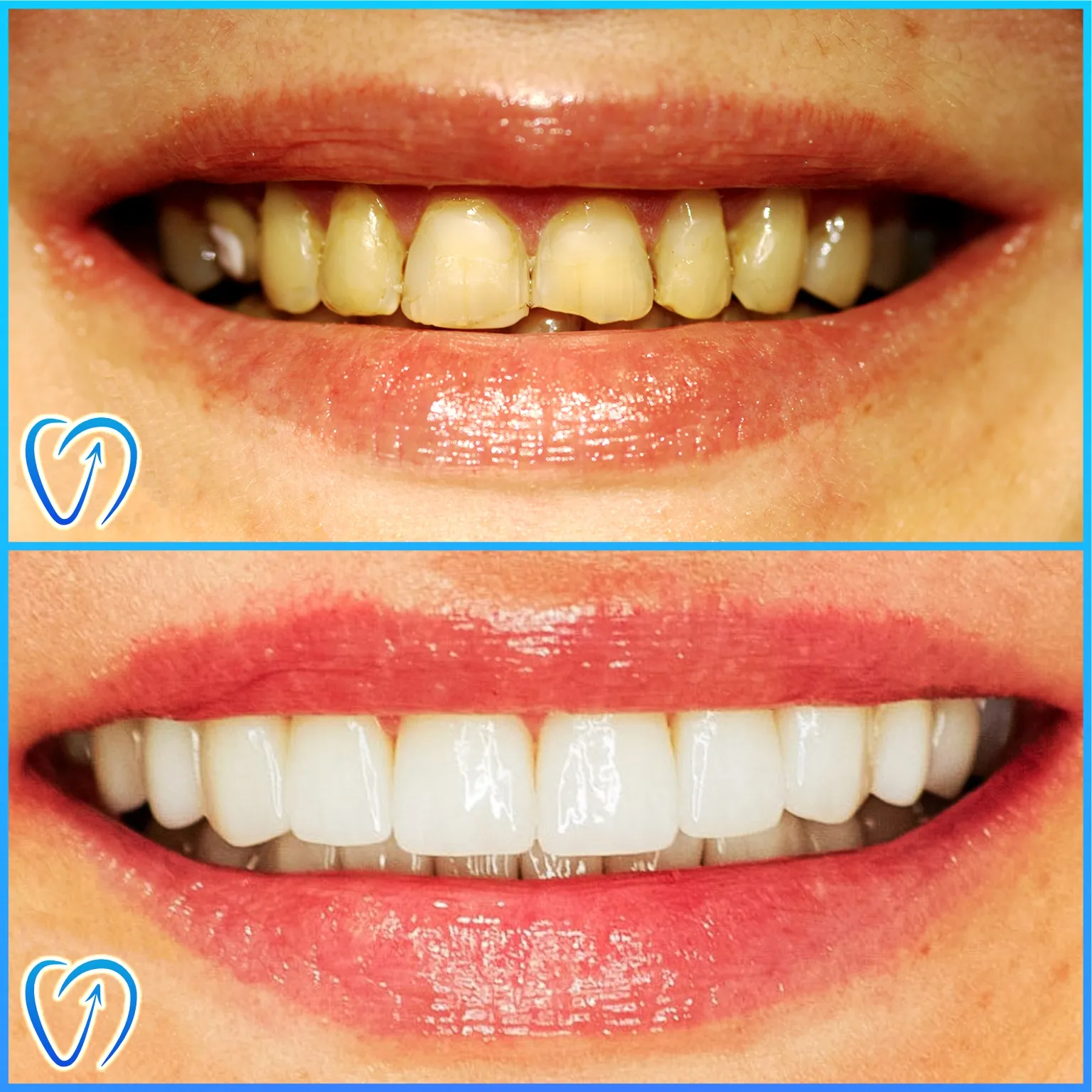 caz 2 transformare aparat dentar implant dentar fatete 004