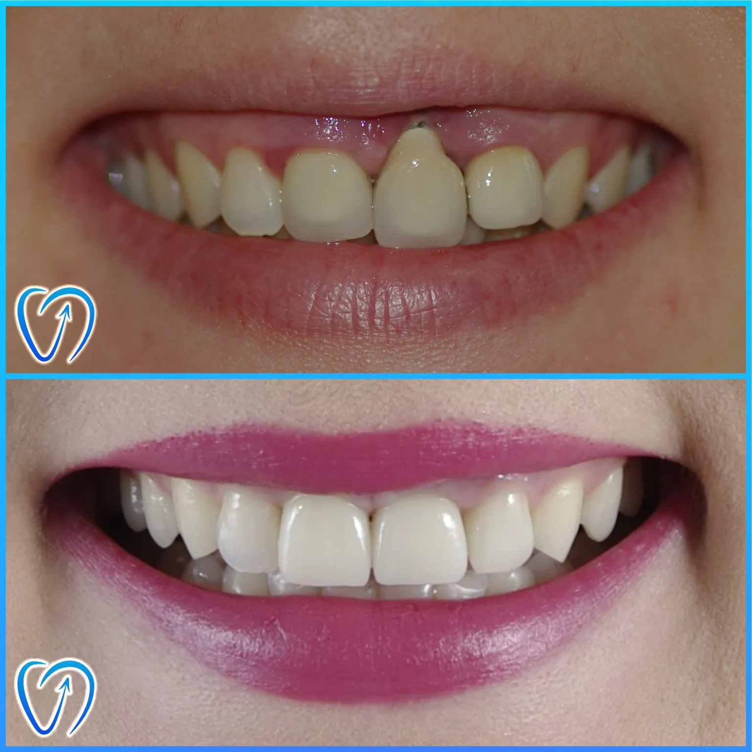 caz 8 urgenta pe implant prin tratament complex coroane zirconiu 003