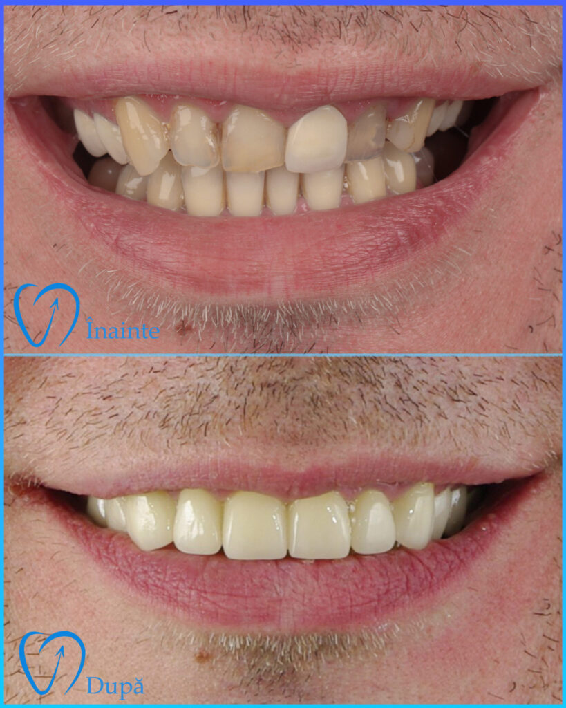 coroana dentara 2 scaled.jpg
